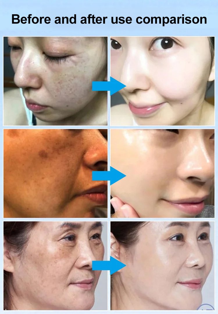 Spot Fading Urea Cream