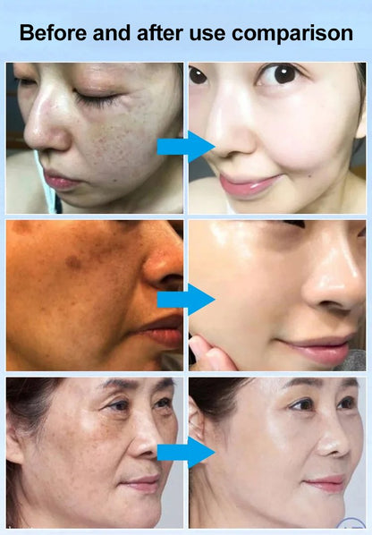 Spot Fading Urea Cream